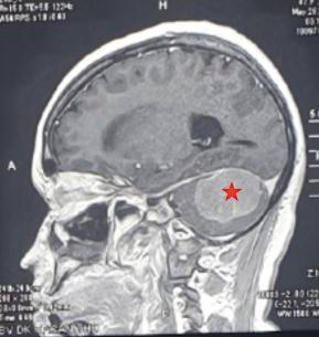 Phẫu thuật thành công cho bệnh nhân u màng não ở vị trí hiếm gặp 