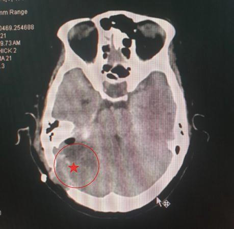 Phẫu thuật thành công cho bệnh nhân u màng não ở vị trí hiếm gặp 