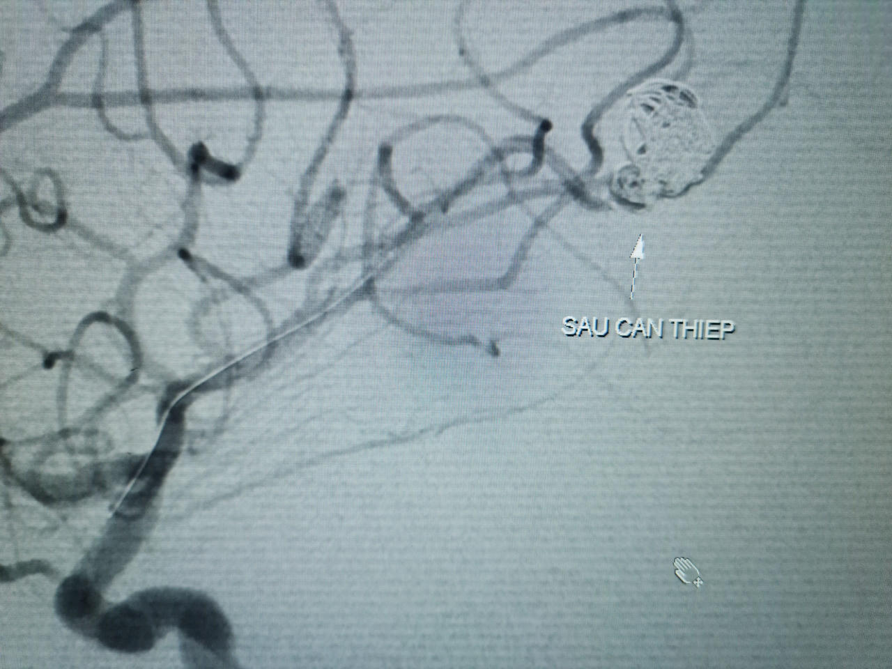 Cứu sống bệnh nhi 11 tuổi vỡ túi phình mạch máu não 