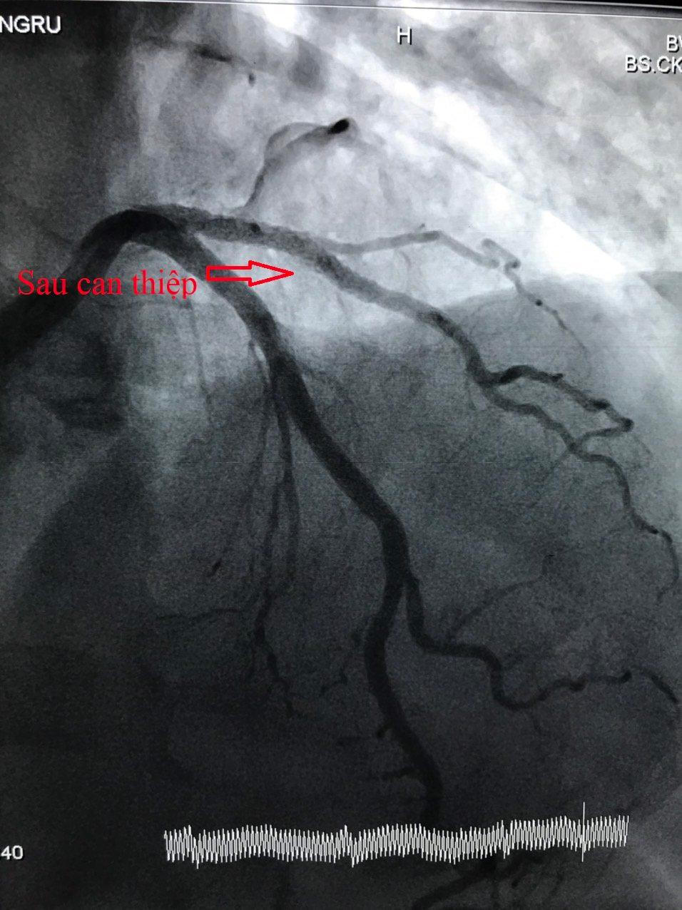 Cứu sống nam bệnh nhân quốc tịch Trung Quốc bị nhồi máu cơ tim cấp 