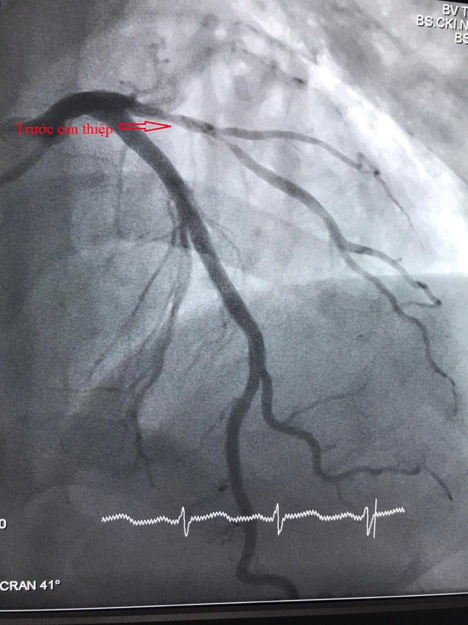 Cứu sống nam bệnh nhân quốc tịch Trung Quốc bị nhồi máu cơ tim cấp 