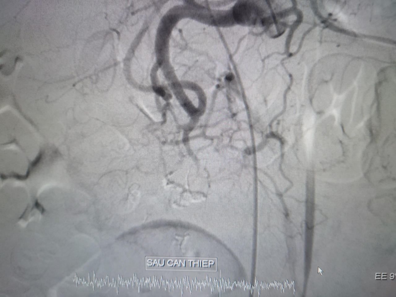 Cứu sống bệnh nhân bị vỡ phình động mạch vị tá tràng nguy kịch