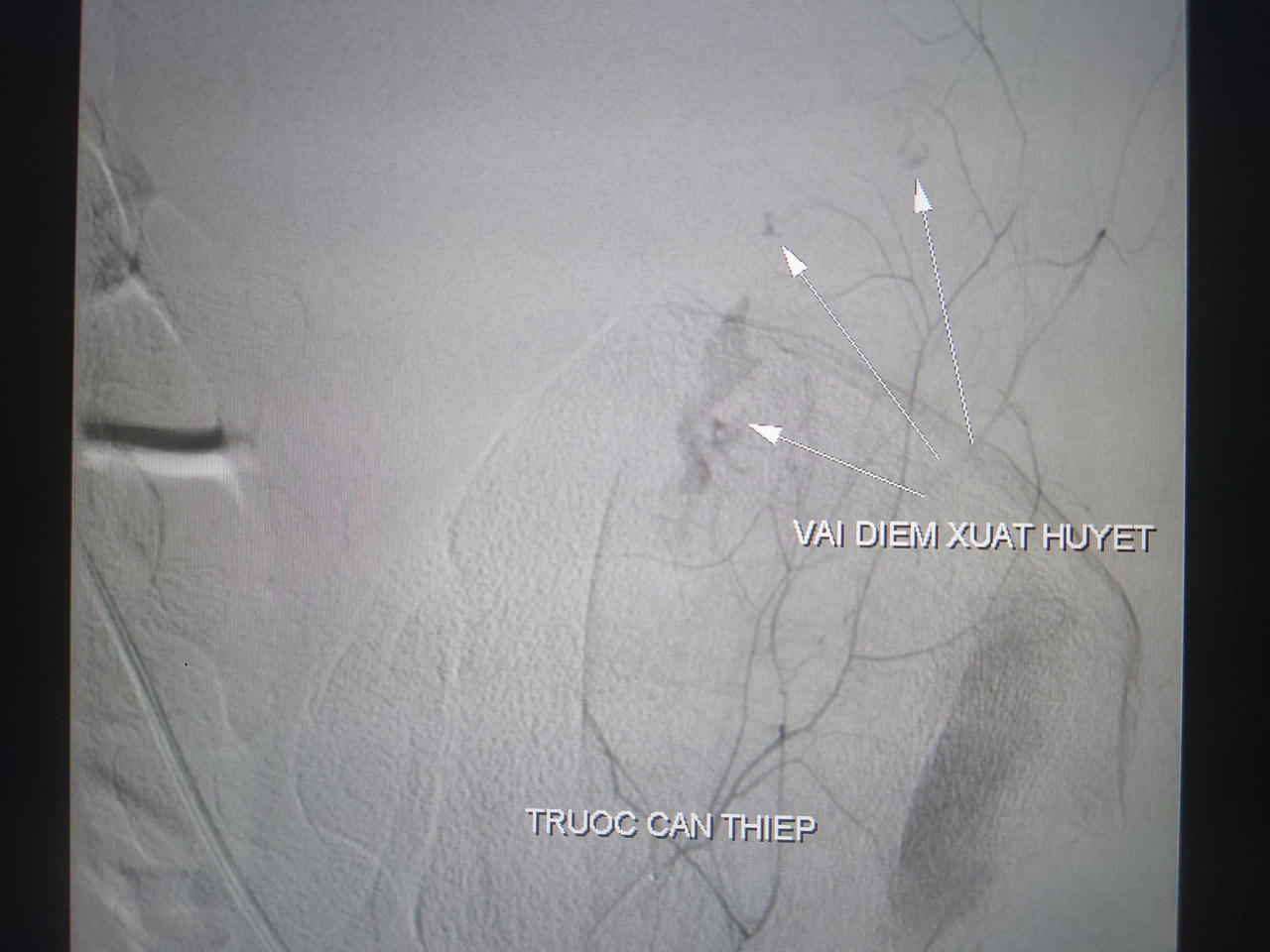 Cứu bệnh nhân sốt xuất huyết biến chứng hiếm gặp 2 lần nguy kịch