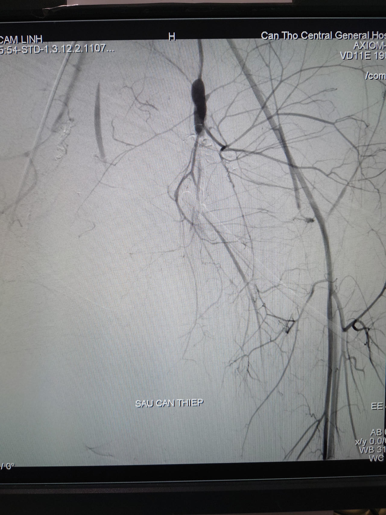 Huy động nhiều ê-kip bác sĩ cứu cô gái bị tai nạn đa chấn thương nguy kịch 