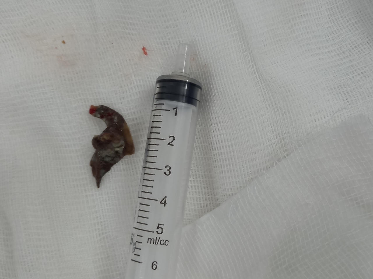 Xương cá mắc trong phổi người đàn ông suốt 4 tuần 