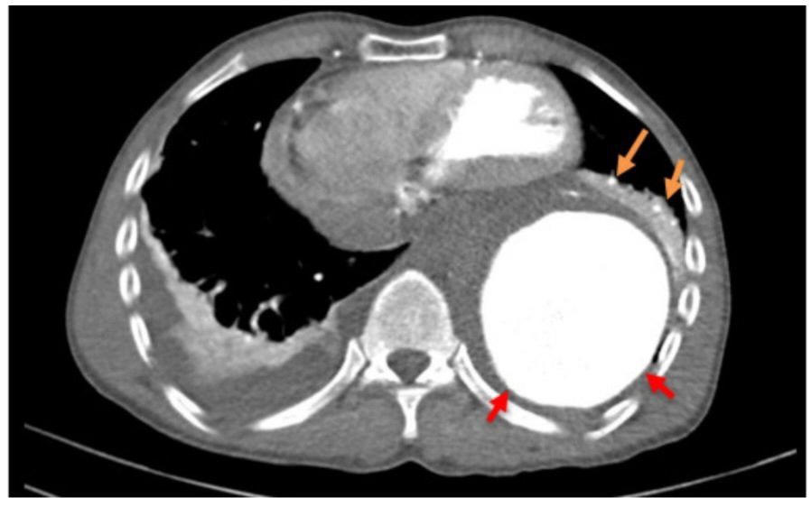 Cứu bệnh nhân người Campuchia vỡ phình khổng lồ động mạnh chủ ngực 