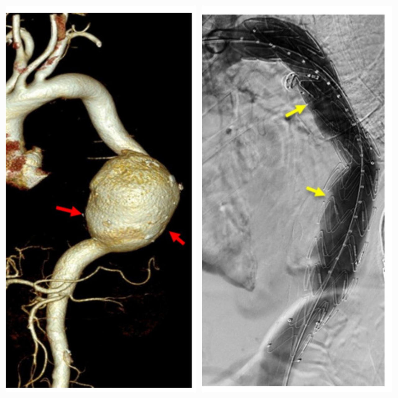 Cứu bệnh nhân người Campuchia vỡ phình khổng lồ động mạnh chủ ngực 