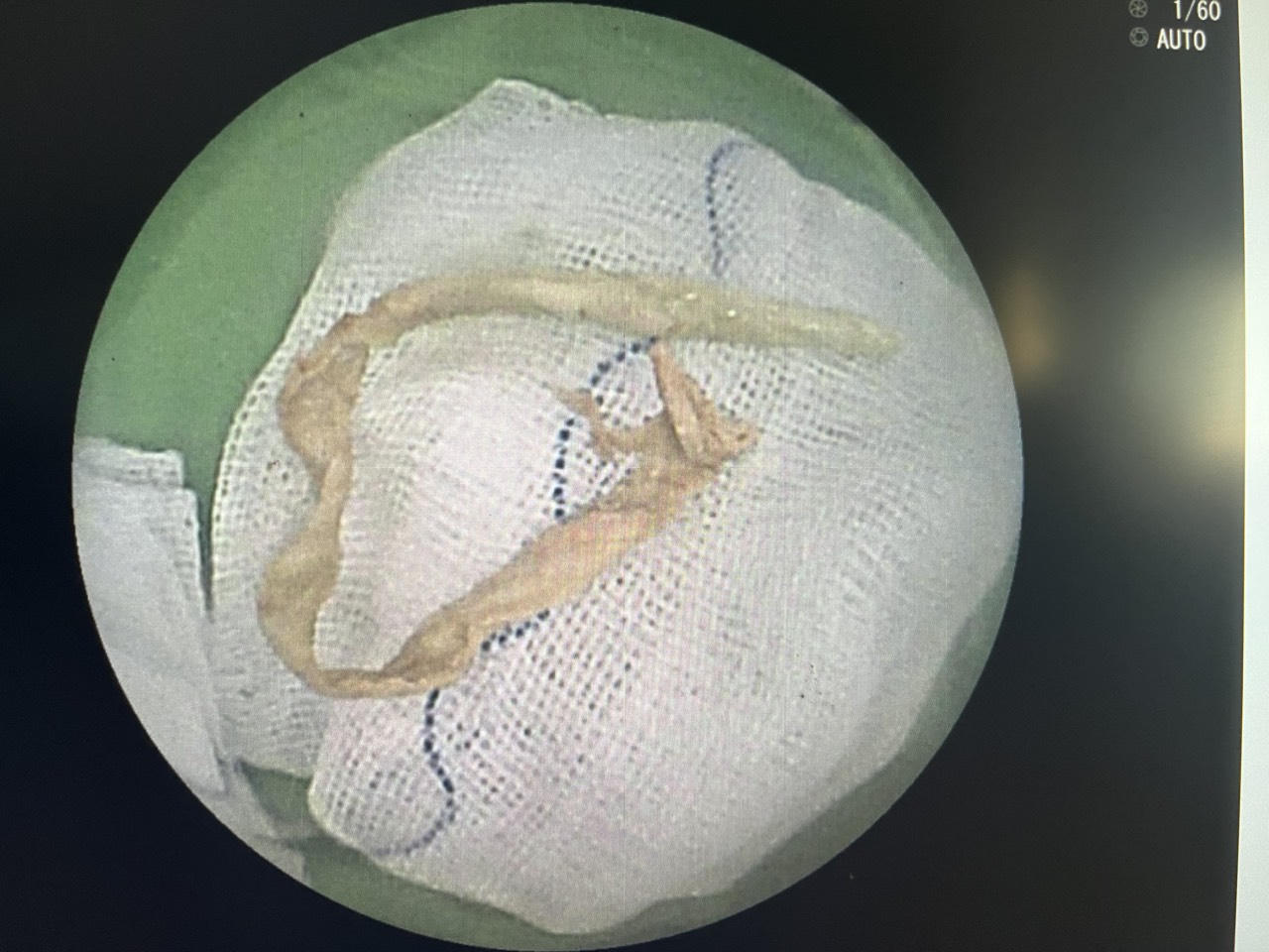 Đoạn khăn giấy dài 15cm trong phế quản người đàn ông 