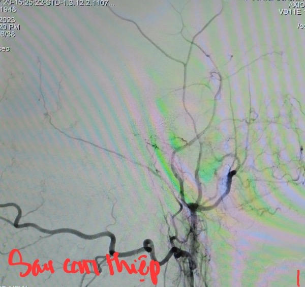 Điều trị thành công cho bệnh nhân nhiều lỗ rò động mạch cảnh - xoang hang ở Cần Thơ 