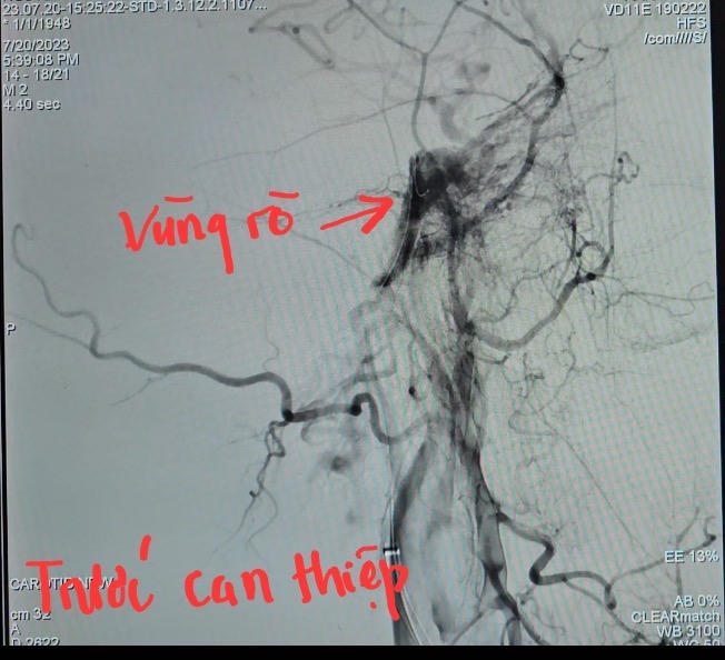 Điều trị thành công cho bệnh nhân nhiều lỗ rò động mạch cảnh - xoang hang ở Cần Thơ 