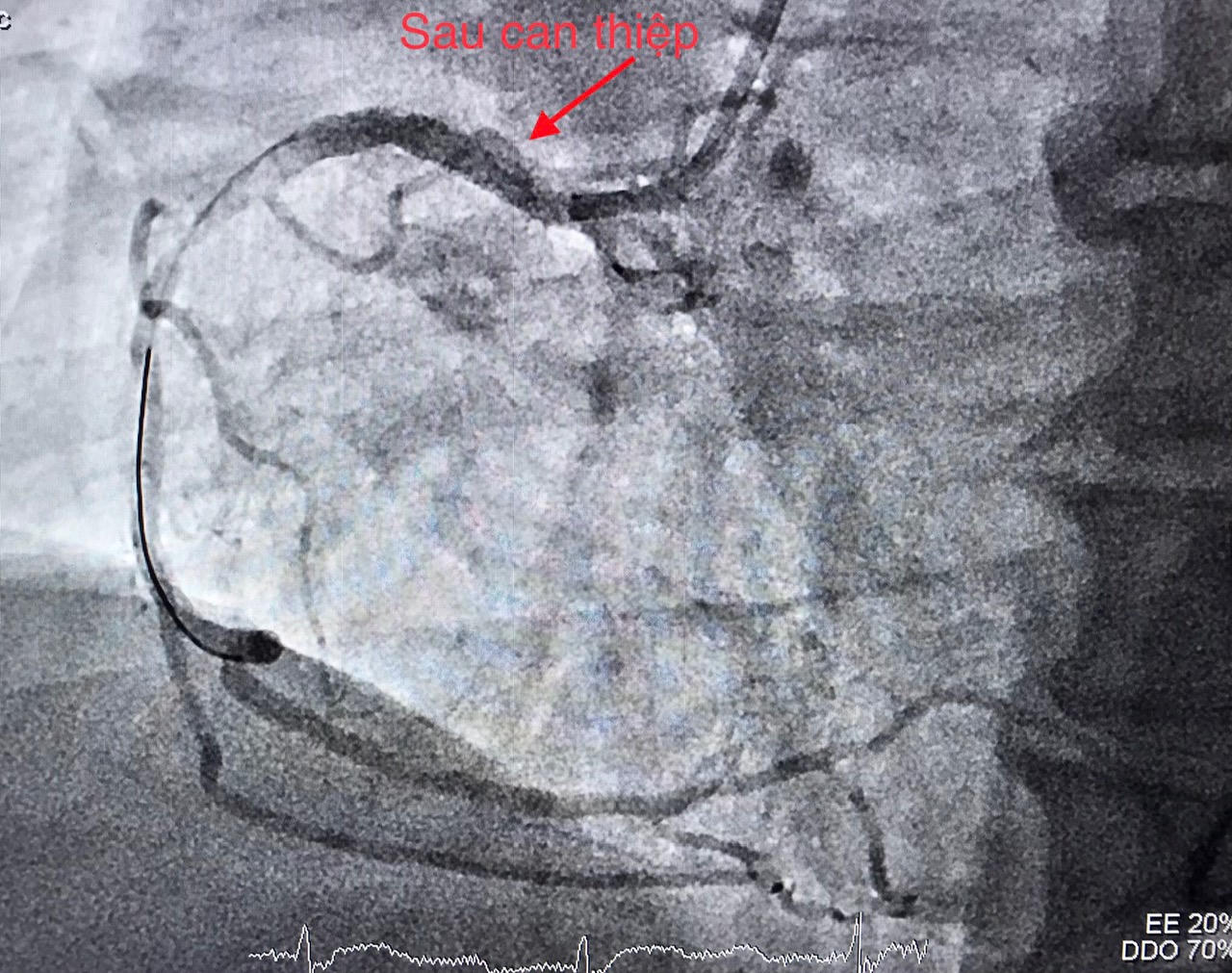 Cứu bệnh nhân cùng lúc bị nhồi máu cơ tim và đột quỵ 