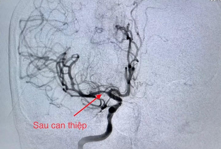 Cứu bệnh nhân cùng lúc bị nhồi máu cơ tim và đột quỵ 