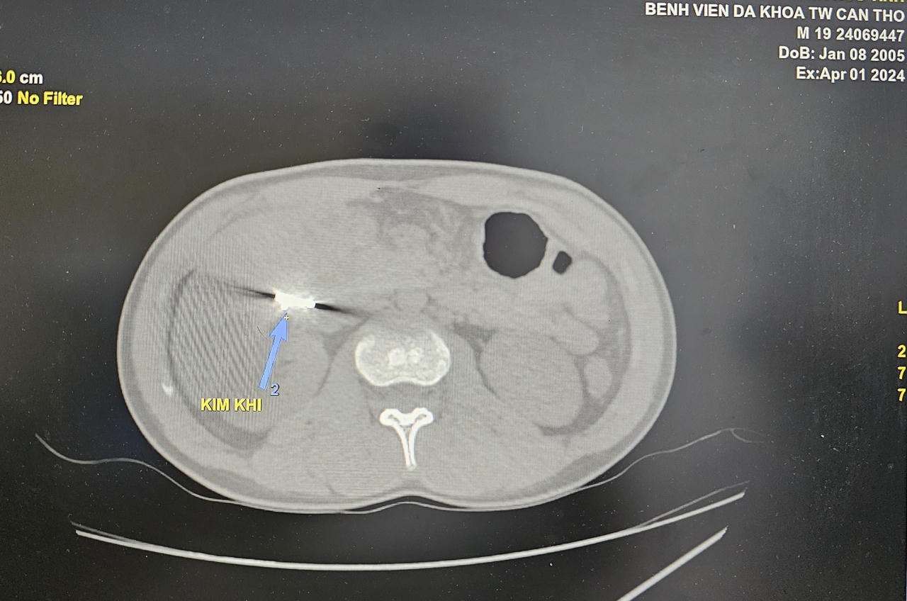 Hy hữu mắt xích máy cưa nằm trong bụng nam thanh niên hơn 2 tuần 