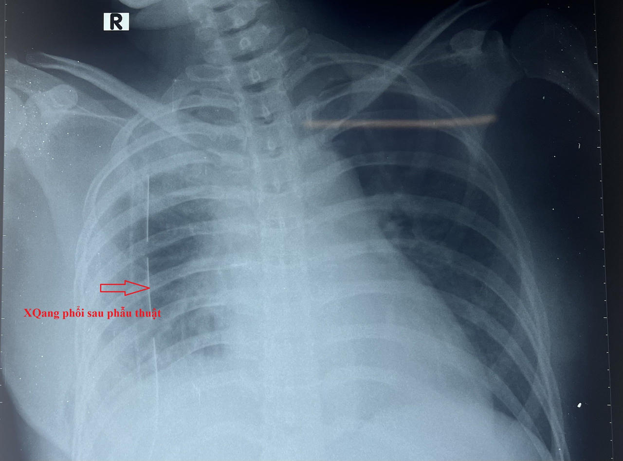 Cứu sống bệnh nhân nguy kịch do đứt rời phế quản gốc bên phải