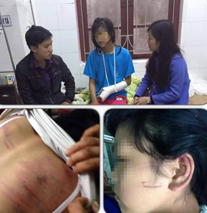 Bé gái 14 tuổi bị bố “ngộ rượu” đánh phải nhập viện