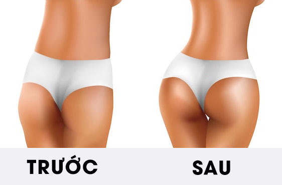 Làm đẹp vòng 3 bằng phương pháp nào?