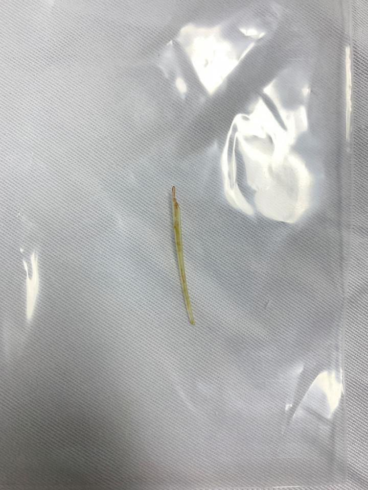 Người đàn ông 50 tuổi thủng ruột do hóc xương cá