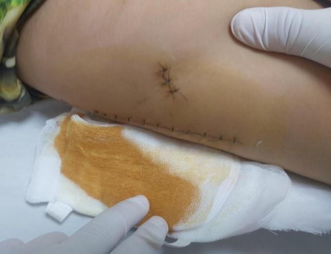 Bé 5 tuổi bị kéo đâm rách cơ đùi khi giằng co với anh 