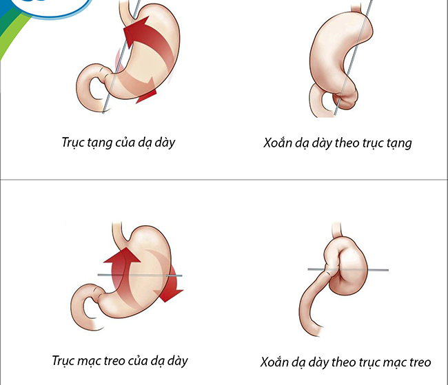 Bé gái 3 tuổi bị bệnh xoắn dạ dày rất hiếm gặp