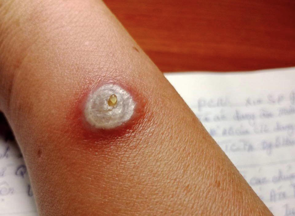 Người phụ nữ nhiễm trùng huyết do chuột cắn