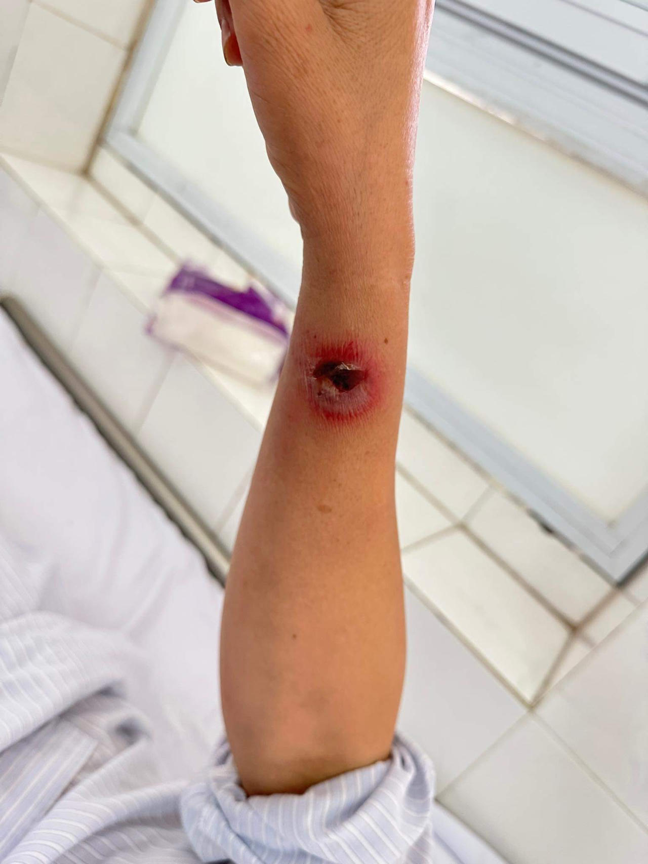 Người phụ nữ nhiễm trùng huyết do chuột cắn