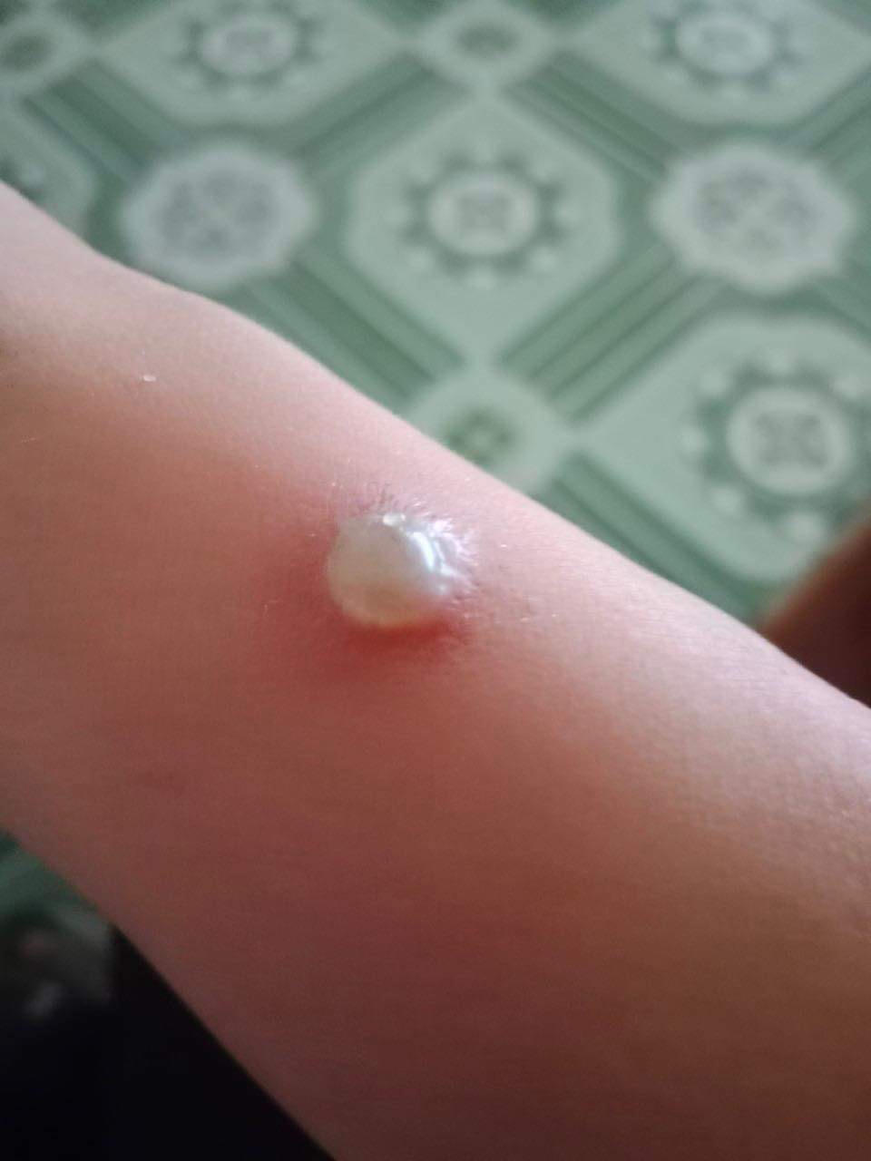 Người phụ nữ nhiễm trùng huyết do chuột cắn