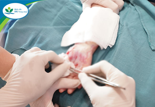 3 trẻ bị bỏng nặng do máy chạy bộ 