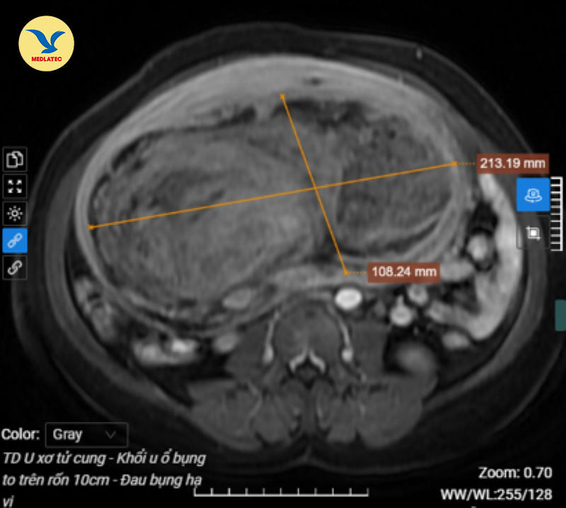 Bệnh viện Đa khoa MEDLATEC phẫu thuật thành công u xơ tử cung nặng 6kg