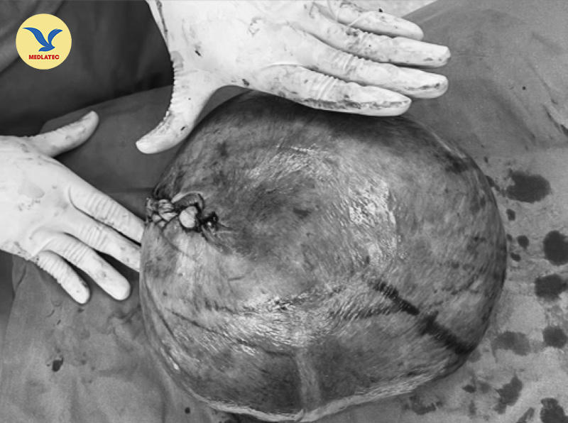 Bệnh viện Đa khoa MEDLATEC phẫu thuật thành công u xơ tử cung nặng 6kg