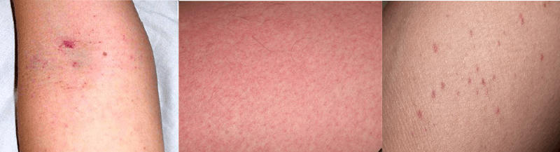 Việc tuyệt đối không làm khi trẻ bị sốt xuất huyết