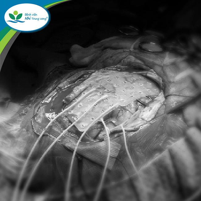 Cứu 2 trẻ khỏi động kinh nguy hiểm nhờ kỹ thuật tiên tiến lần đầu áp dụng tại Việt nam