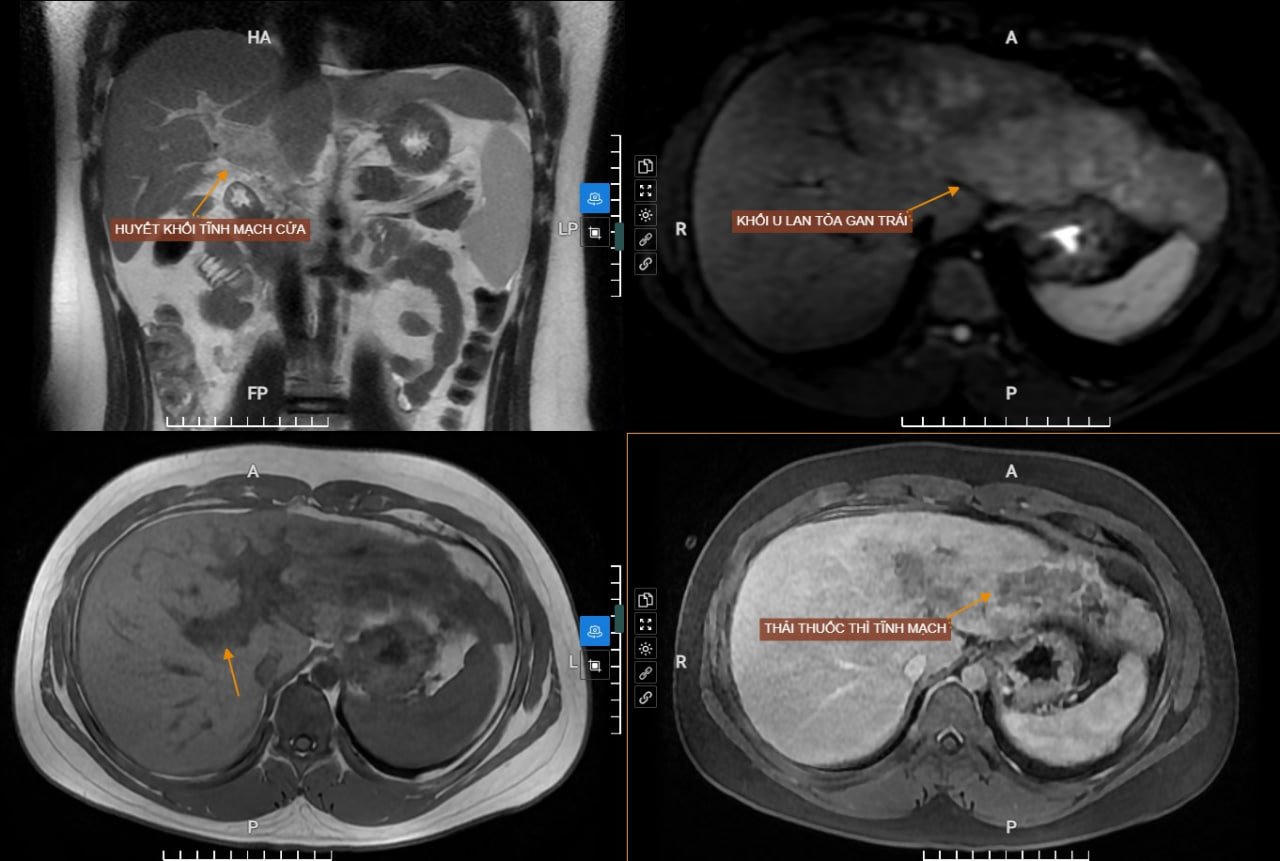 MEDLATEC miễn phí xét nghiệm tầm soát nguy cơ ung thư gan (AFP) nhân dịp khai trương cơ sở mới tại Campuchia 