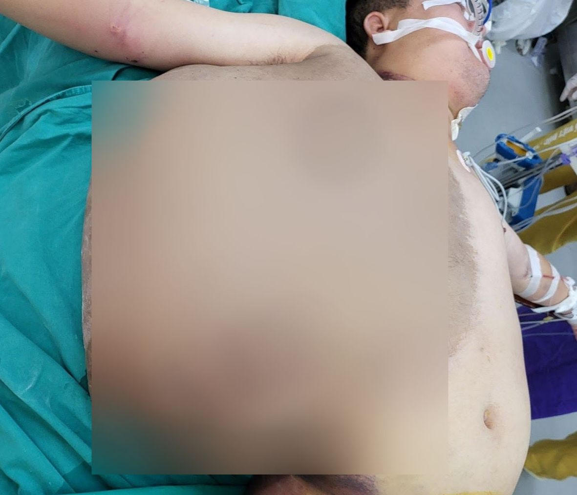 Người đàn ông 39 tuổi 'gánh' khối u to hơn cơ thể