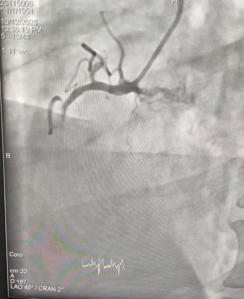 Cấp cứu kịp thời bệnh nhân nước ngoài bị nhồi máu cơ tim cấp