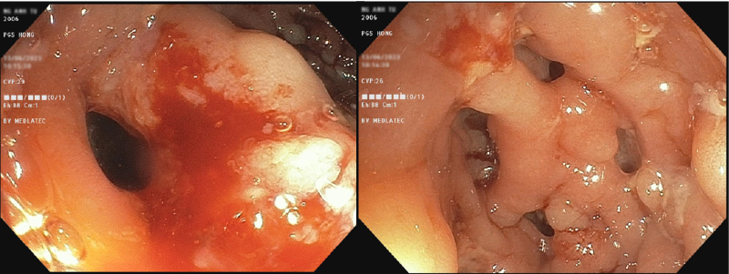 BVĐK MEDLATEC: Giảm 50% phí nội soi thực quản dạ dày và nội soi đại trực tràng