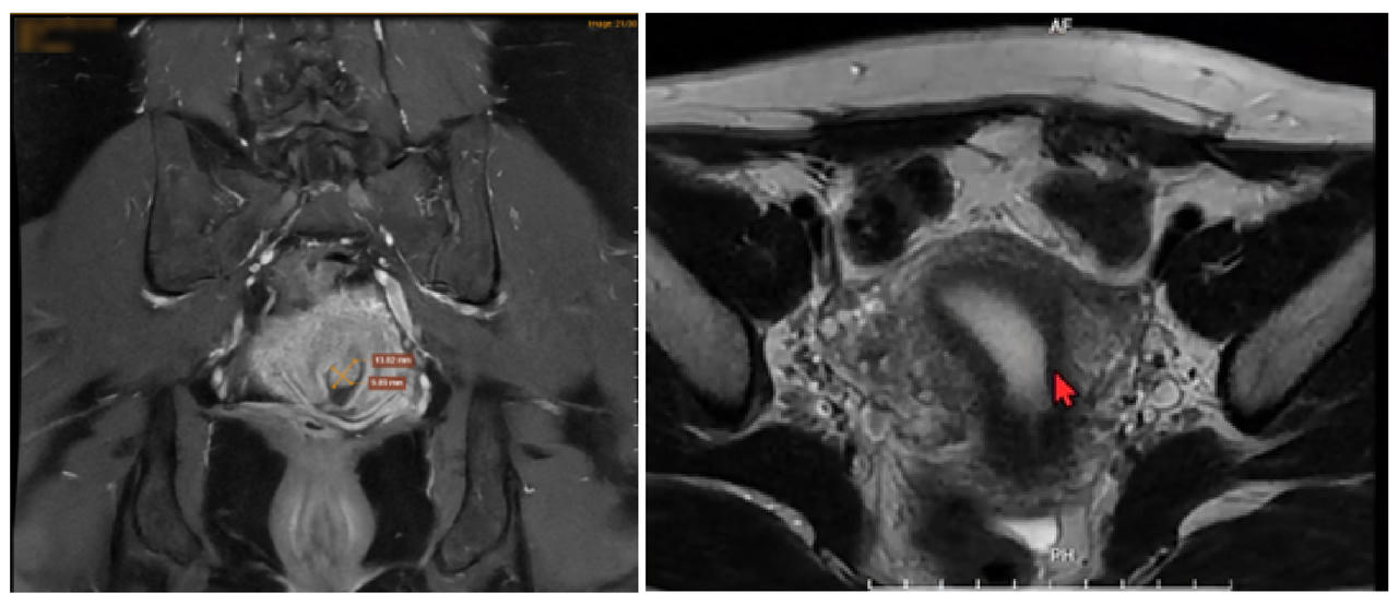 Hành trình thoát khỏi “bệnh lạ” sau 2 năm chung sống với cơn đau của người phụ nữ 37 tuổi