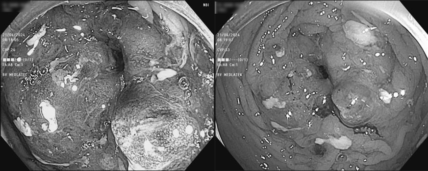 Chủ quan trước dấu hiệu đau bụng kéo dài, đi khám phát hiện ung thư đại trực tràng giai đoạn muộn