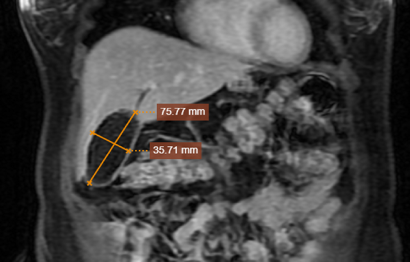 Phẫu thuật thành công lấy ra hàng trăm viên sỏi túi mật của bệnh nhân nước ngoài