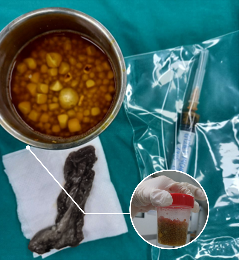 Phẫu thuật thành công lấy ra hàng trăm viên sỏi túi mật của bệnh nhân nước ngoài