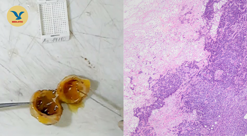 Bệnh nhân người Campuchia phát hiện mắc ung thư tuyến vú xâm nhập nhờ tiêu chuẩn 'vàng'