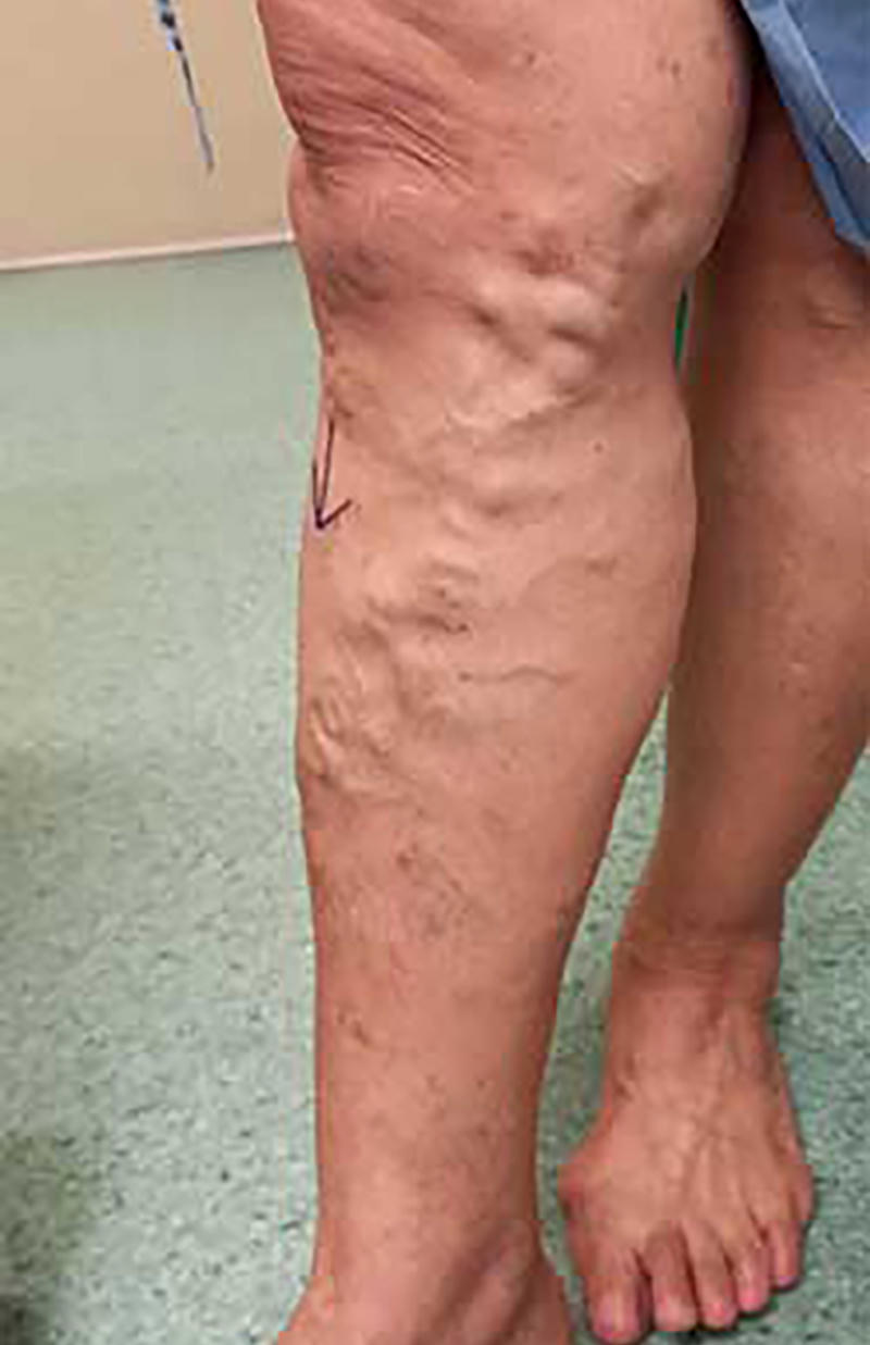 Bệnh viện Đa khoa MEDLATEC - Điều trị suy giãn tĩnh mạch phức tạp bằng đốt laser