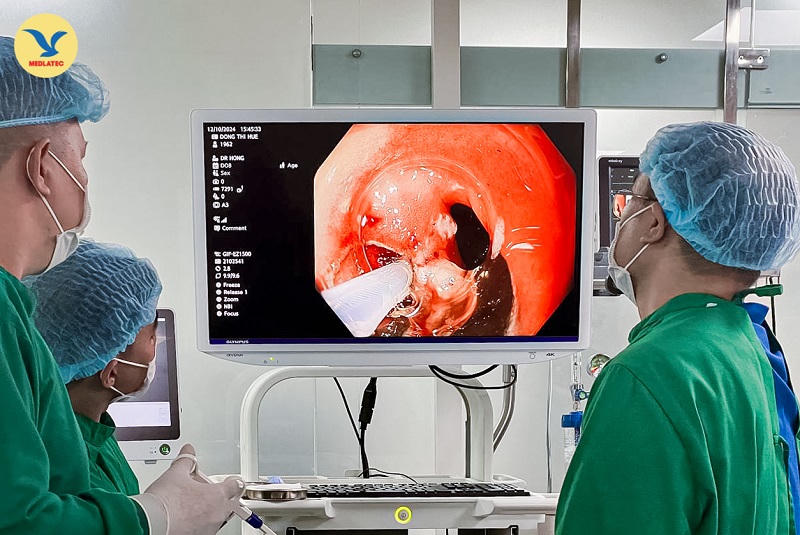 Thổi bay u dưới niêm mạc không cần phẫu thuật - “cuộc cách mạng” trong điều trị sớm ung thư dạ dày