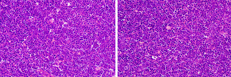 Nổi hạch khám không ra bệnh, xét nghiệm tại MEDLATEC phát hiện mắc ung thư