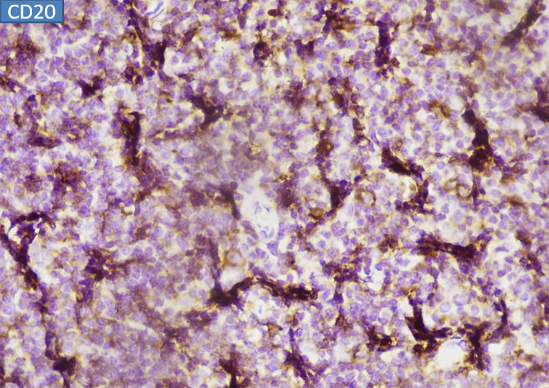 Nổi hạch khám không ra bệnh, xét nghiệm tại MEDLATEC phát hiện mắc ung thư