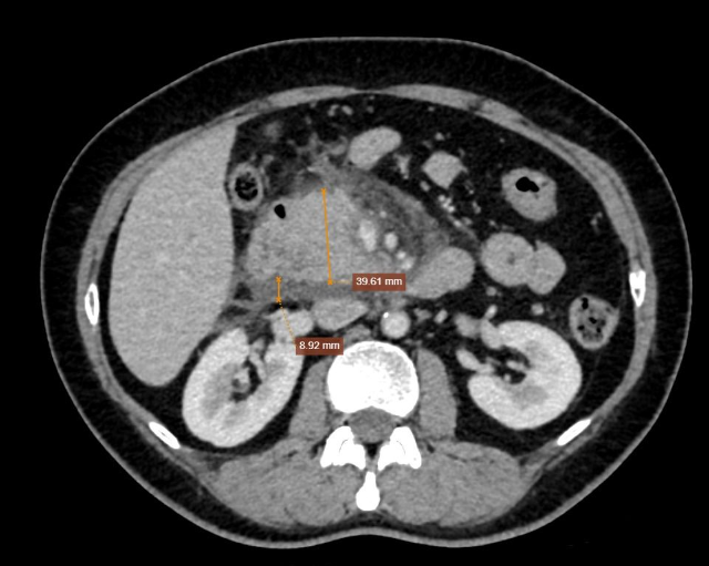 Người phụ nữ 58 tuổi nhập viện điều trị cấp cứu vì thói quen hay gặp
