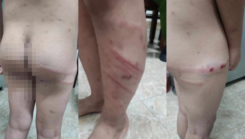 Bé trai 11 tuổi nghi bị mẹ và bạn trai của mẹ bạo hành trong đêm