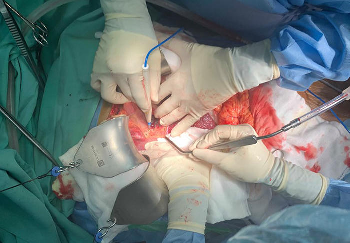 Bệnh viện Trung ương Huế thực hiện thành công 2 ca ghép tạng xuyên Việt trong một ngày