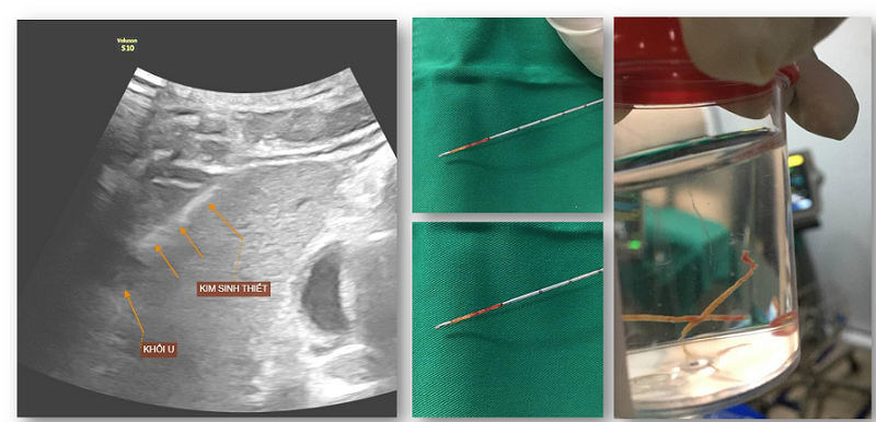 Bệnh viện Đa khoa MEDLATEC điều trị thành công ung thư gan nguyên phát bằng đốt sóng cao tần