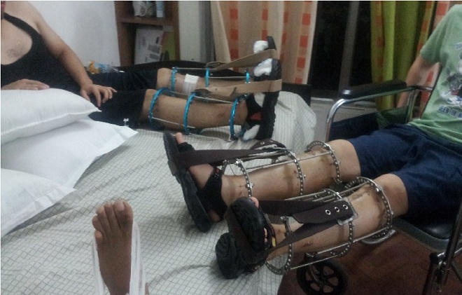 Nở rộ dịch vụ kéo xương tăng chiều cao