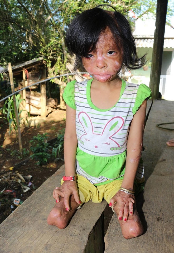 Rơi nước mắt trước cô bé tật nguyền sau ngày bị cha phóng hỏa